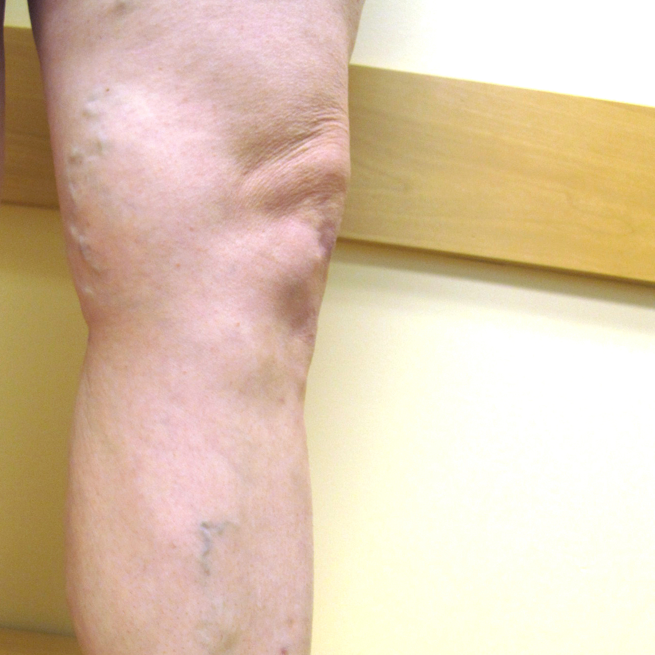 Vein Therapy Skybalance Med Spa