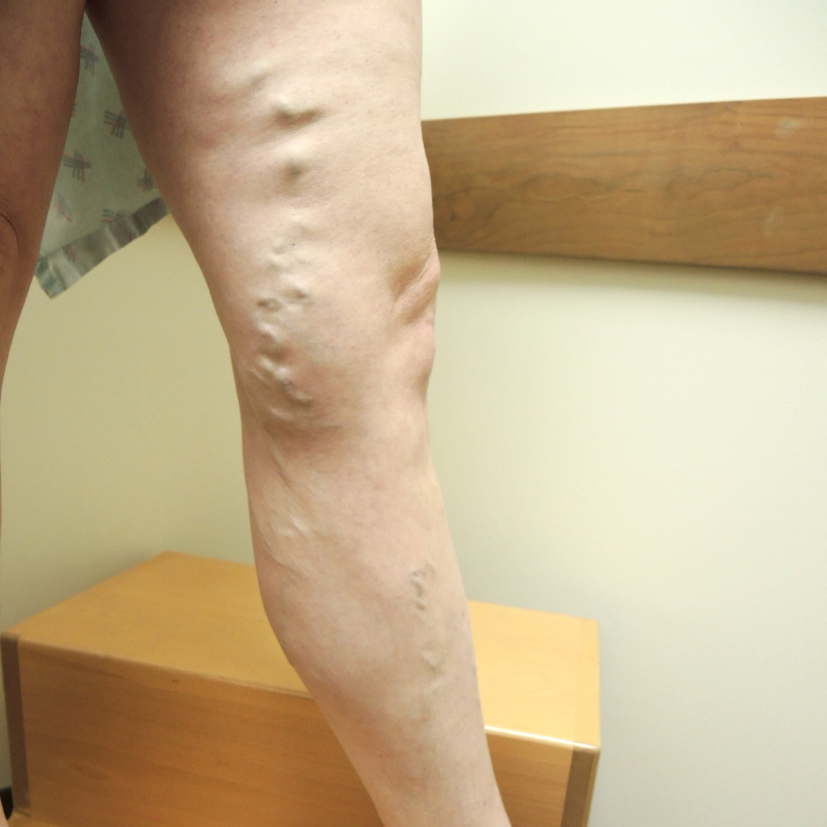 Vein Therapy Skybalance Med Spa
