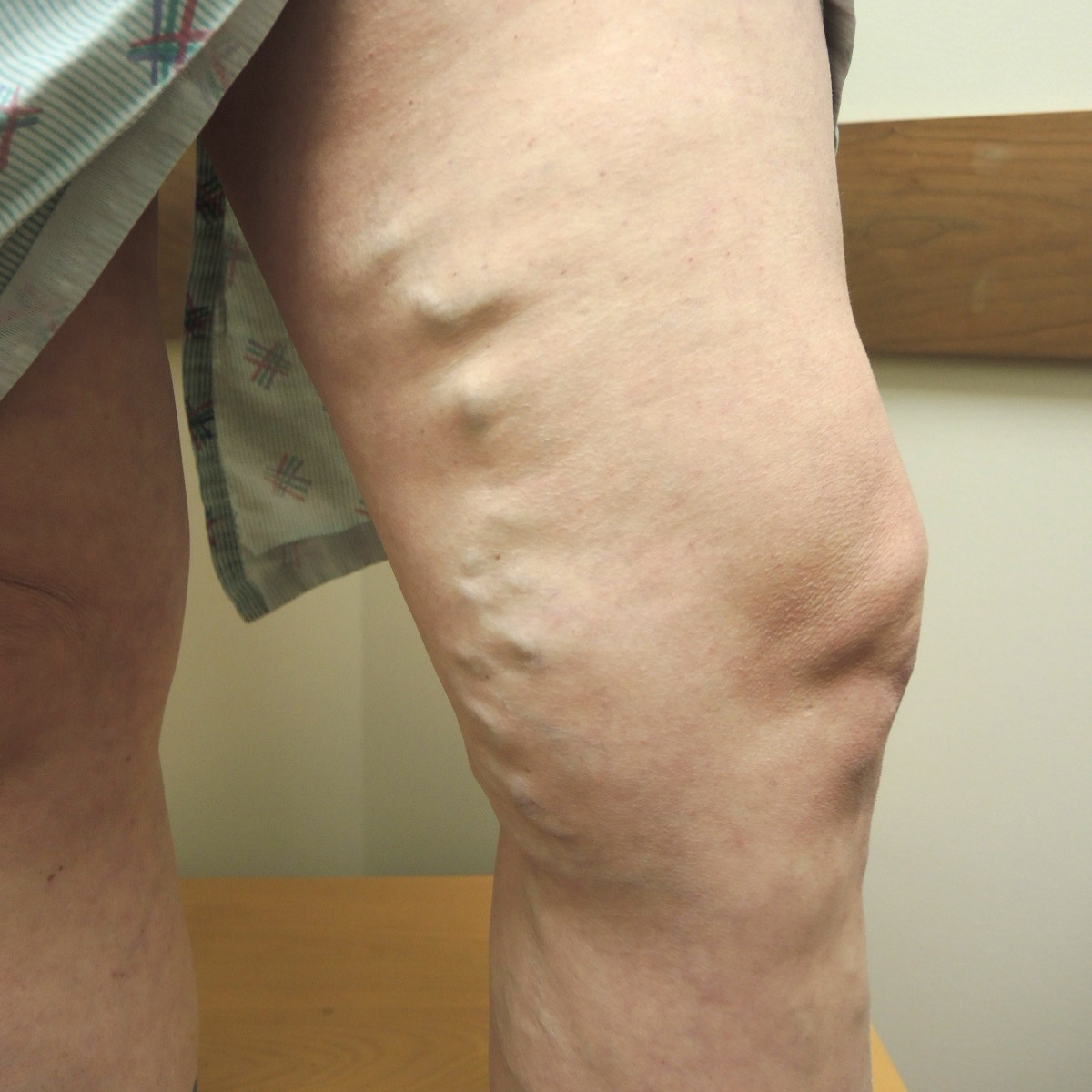 Vein Therapy Skybalance Med Spa