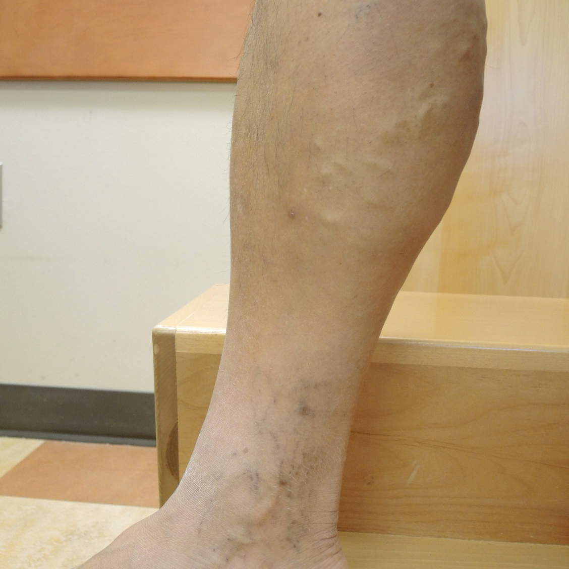 Vein Therapy Skybalance Med Spa