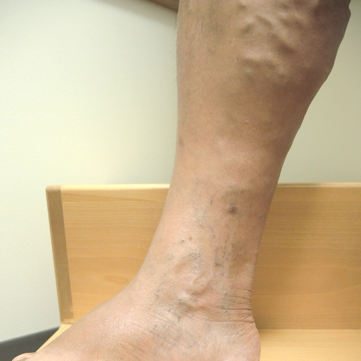 Vein Therapy Skybalance Med Spa