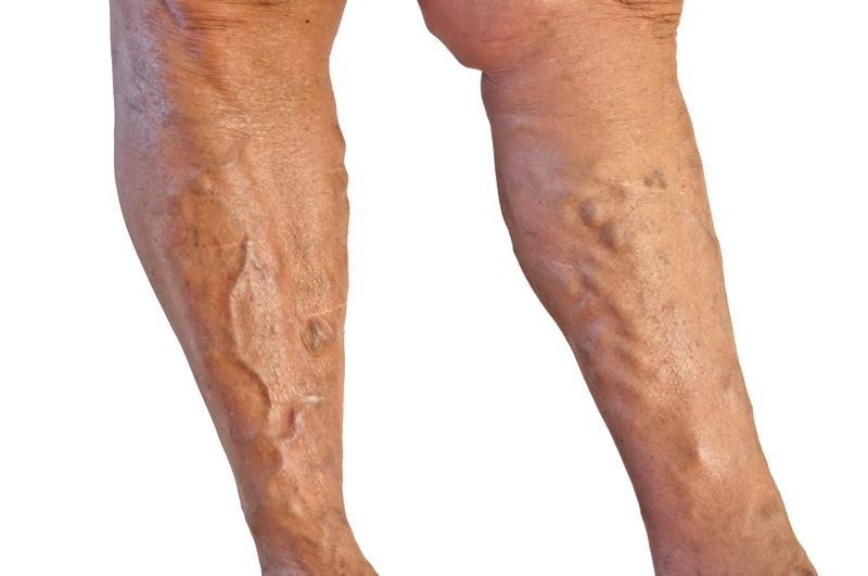 Vein Therapy Skybalance Med Spa