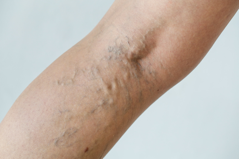 Vein Therapy Skybalance Med Spa