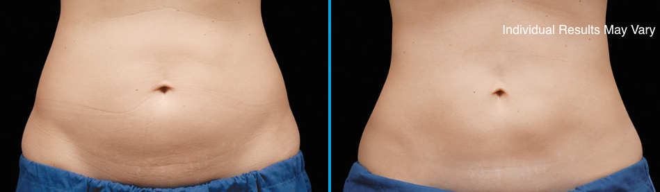 Skybalance Med Spa Coolsculpting Before and After Schaumburg