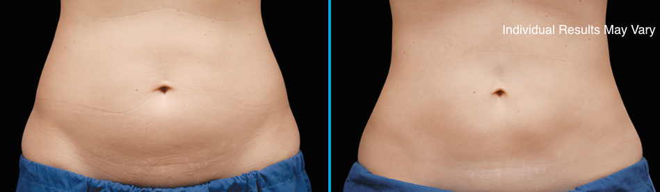 Before and After Coolsculpting Result