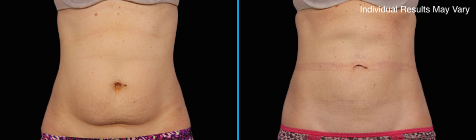 Skybalance Med Spa Coolsculpting Before and After Result