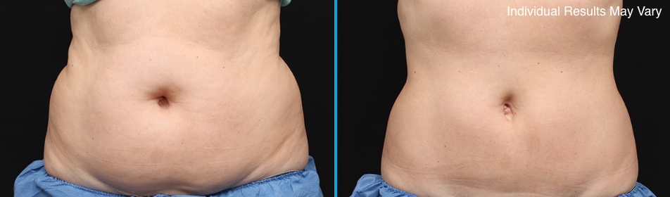 Coolsculpting Before and After Schaumburg