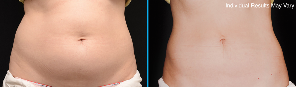Skybalance Med Spa Coolsculpting Before and After