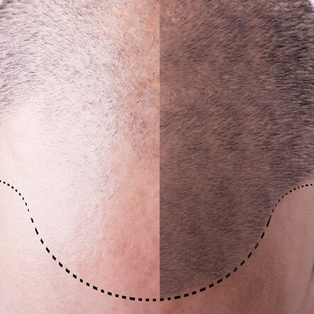 FUE Hair Restoration Schaumburg