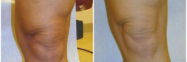 Varicose Vein Treatment Center