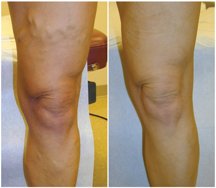 Varicose Vein Treatment Center