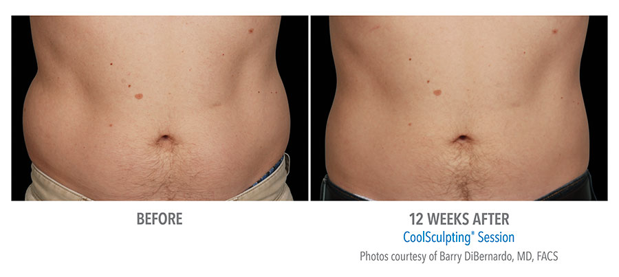 Before And After Photos Of Fat Removal