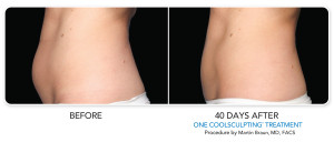 CoolSculpting Cost | Non-Surgical Fat Reduction | MedSpa | Chicago