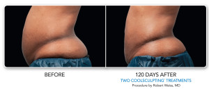 CoolSculpting | Non-Surgical Fat Reduction | MedSpa | Chicago | IL