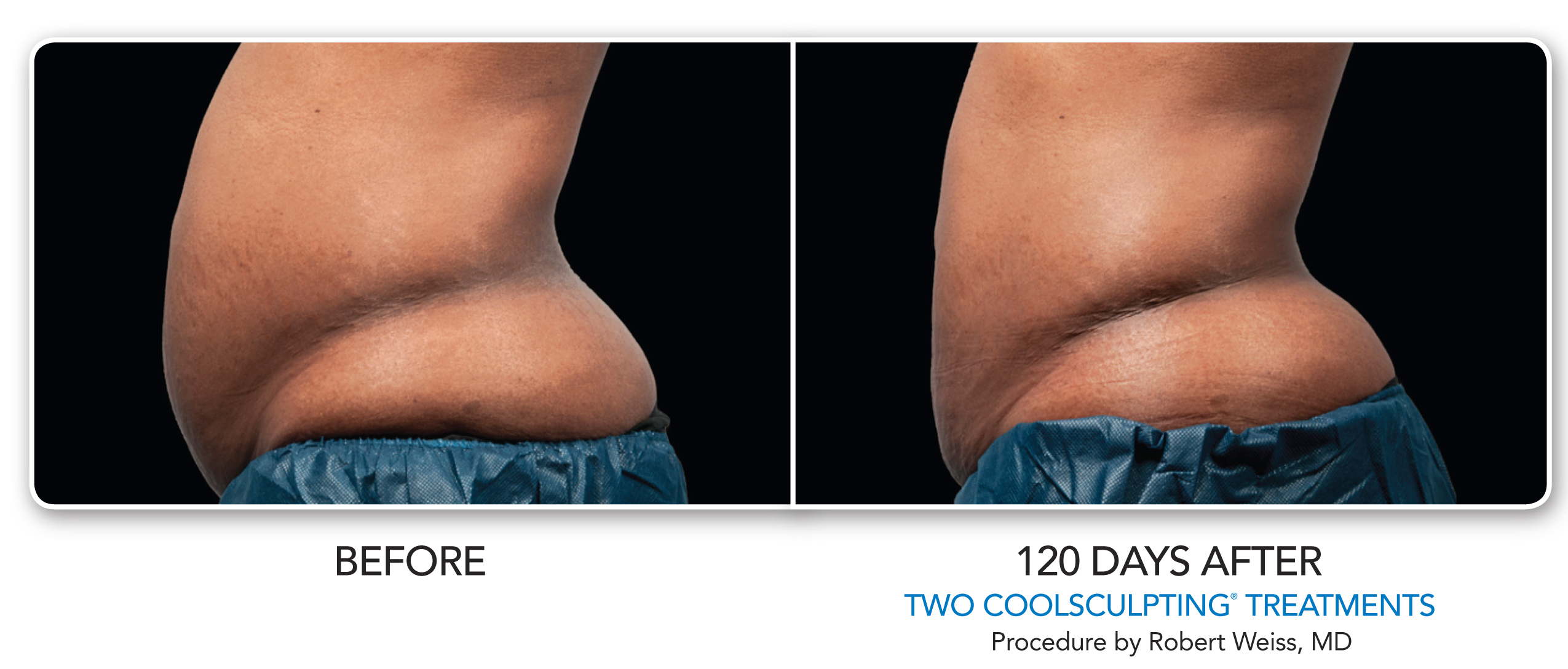 Coolsculpting Scottsdale Cost