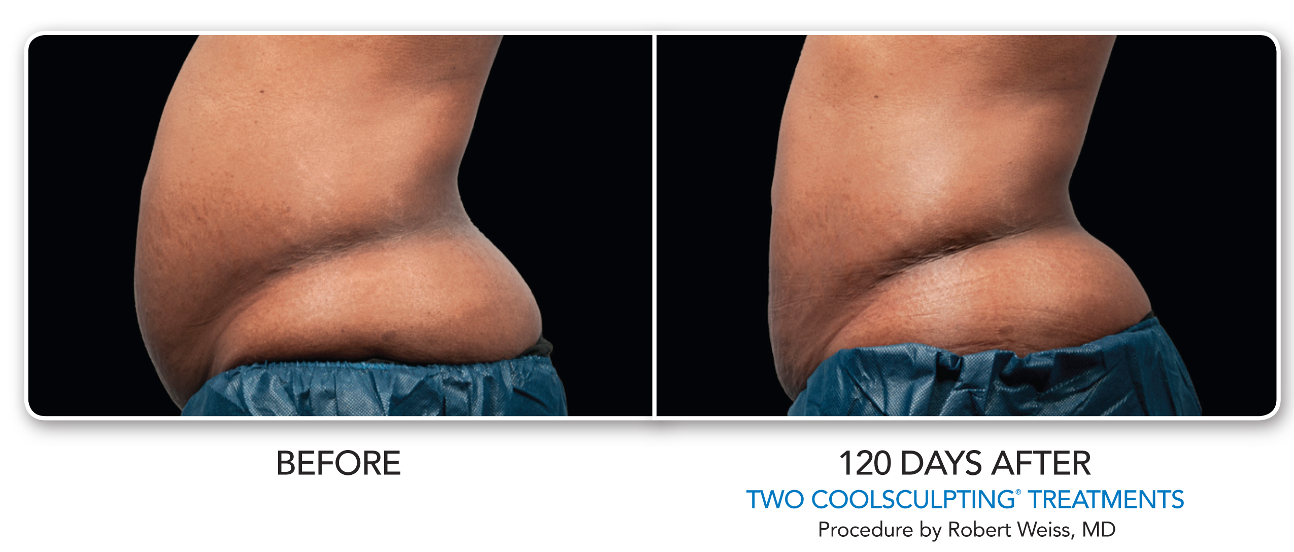 Coolsculpting Phoenix