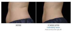 B&A-Light-AB-p01-2Set-12wk-LSide_LoRes