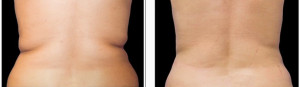 coolsculpting-before-and-after-photo1-1024x298