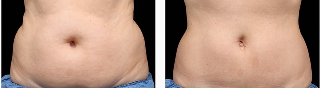 coolsculpting-before-and-after-photos1-1024x282