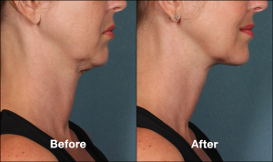 Kybella Double Chin Removal Before and After Pictures | Schaumburg