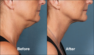 Chin Fat Reduction Kybella Injections | Schaumburg | Chicago Med Spa