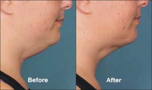 Kybella Double Chin Treatment Cost | Schaumburg Medical Spa | Chicago