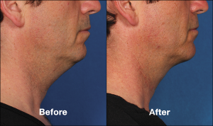 How Long Do Kybella Injections Last? | Schaumburg Medical Spa | Chicago