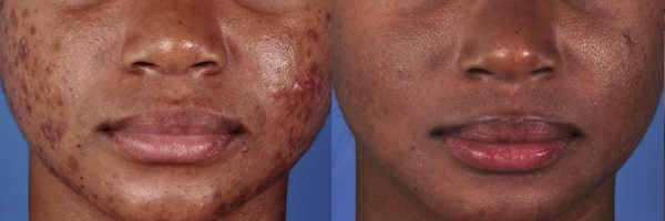 Acne Treatment