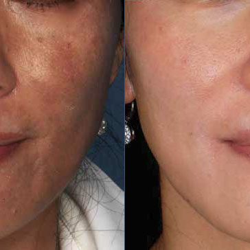 Hyperpigmentation