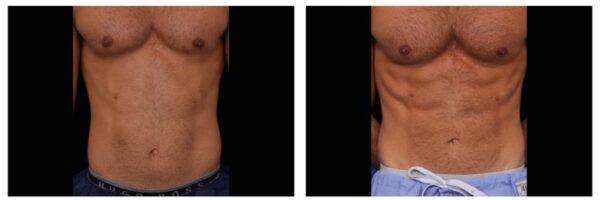 Before and after image of ABS