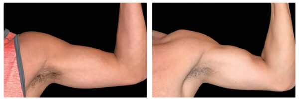 before-after-arms1