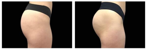 Buttocks Before and after