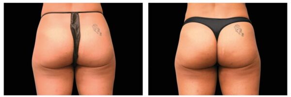 Buttock Lift Before & After Photo Gallery
