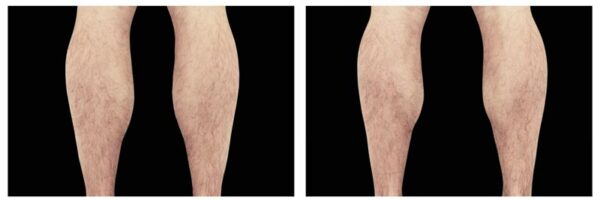 before-after-legs1