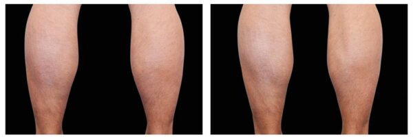 before-after-legs2