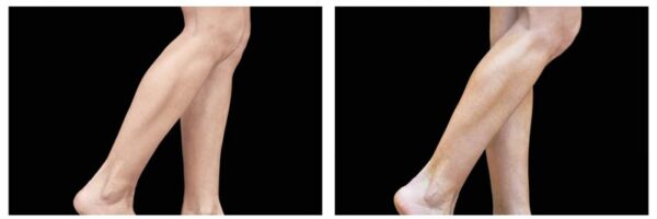 before-after-legs4