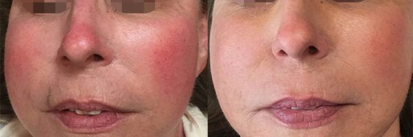 DiamondGlow Skin Resurfacing Technology