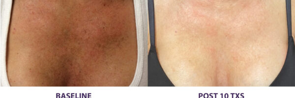 Diamond Glow Treatment
