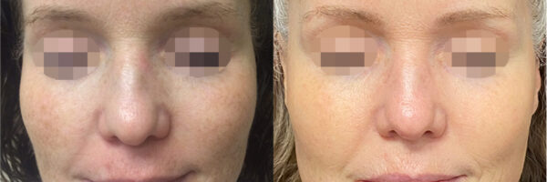 Skin Resurfacing