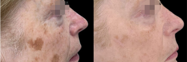 Skin Infusion