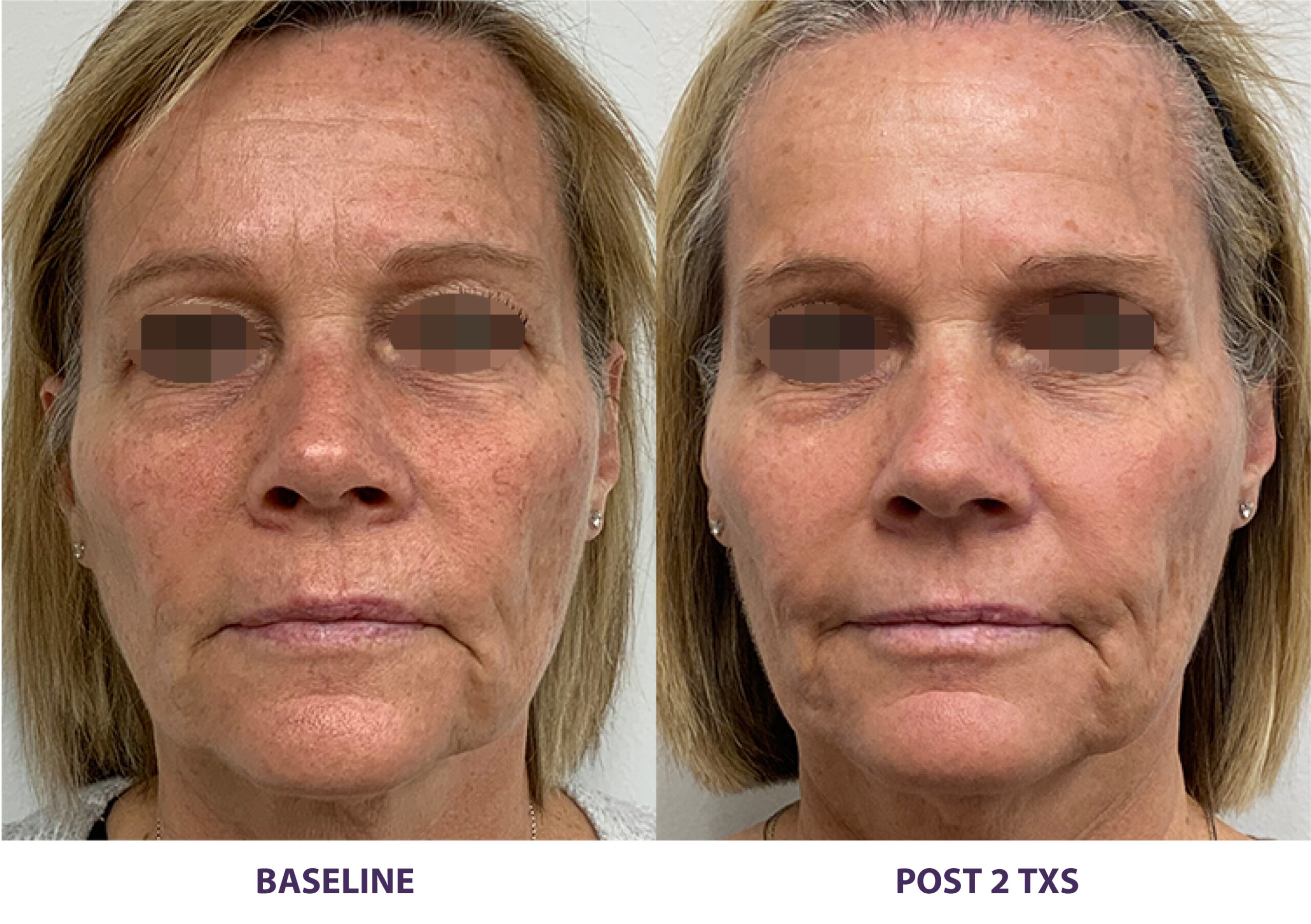 ba-5 Diamond Glow Treatment